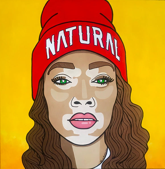 Winnie Harlow - VITILIGO BEAUTY