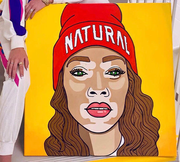 Winnie Harlow - VITILIGO BEAUTY