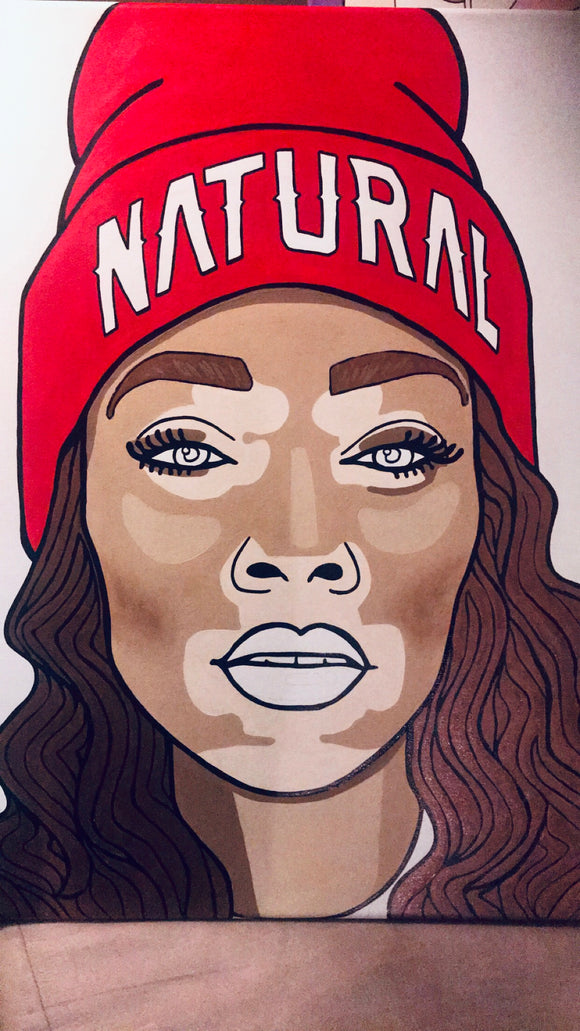 Winnie Harlow - VITILIGO BEAUTY